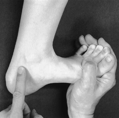 dorsiflexion compression test|Diagnosis .